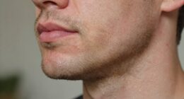 beard itch relief tips