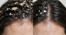 dandruff dry scalp differences