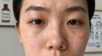 debunking acne misconceptions
