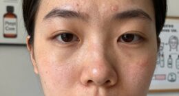 debunking acne misconceptions