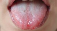 tongue cleaning prevents bad breath