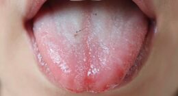 tongue cleaning prevents bad breath