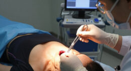 Doctors Retrieved Nails From Patient's Bowels